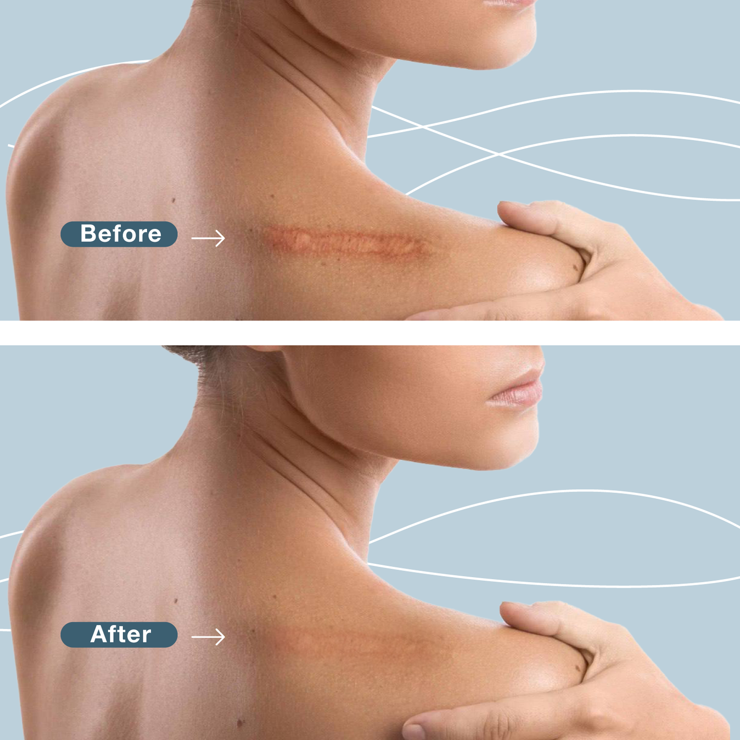Silicone Scar Sheet Roll