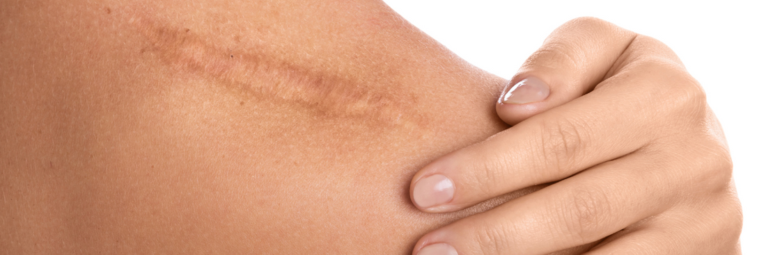 10 Effective and Safe Ways to Treat Scars